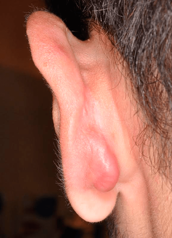queloide en la oreja por piercing
