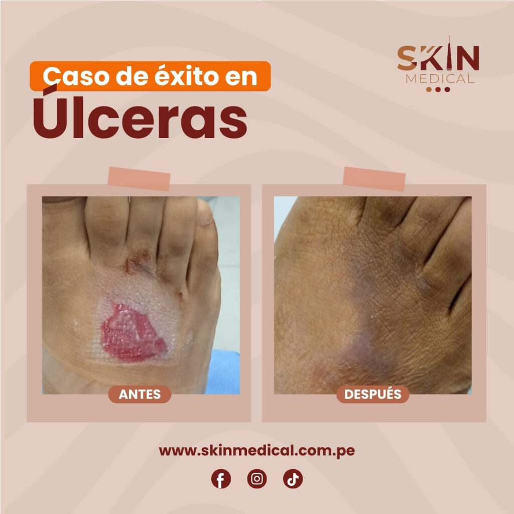 ulceras: antes y despues