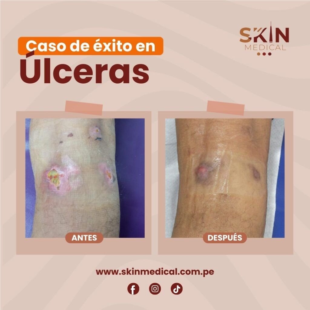 Antes y después de tratamiento de úlceras en pierna con curación avanzada de heridas en SkinMedical.