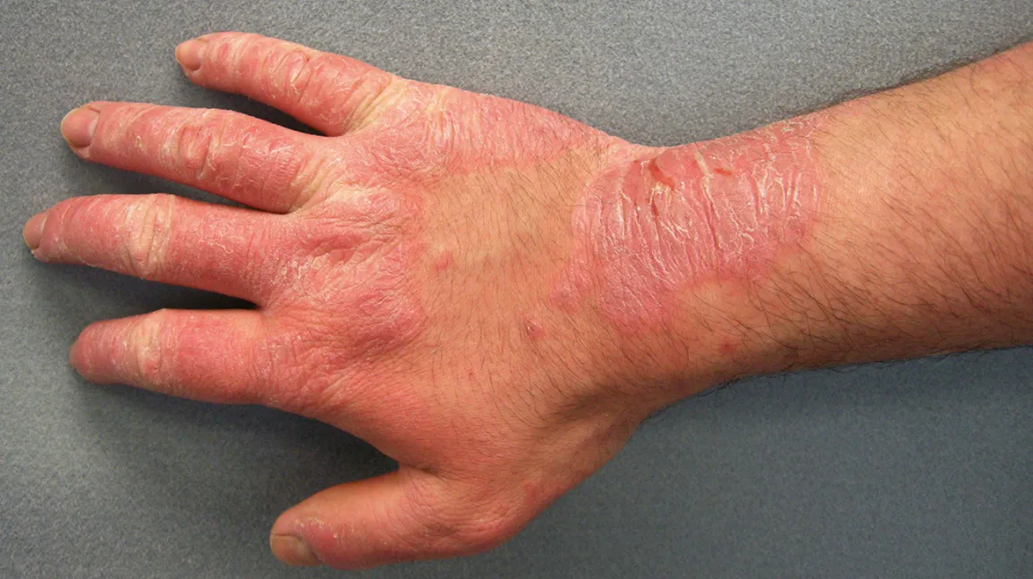ampollas en la mano
