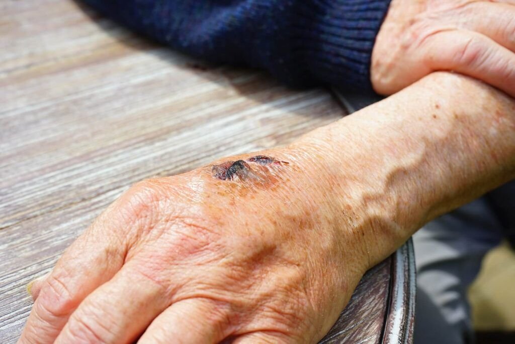 escaras en adultos mayores