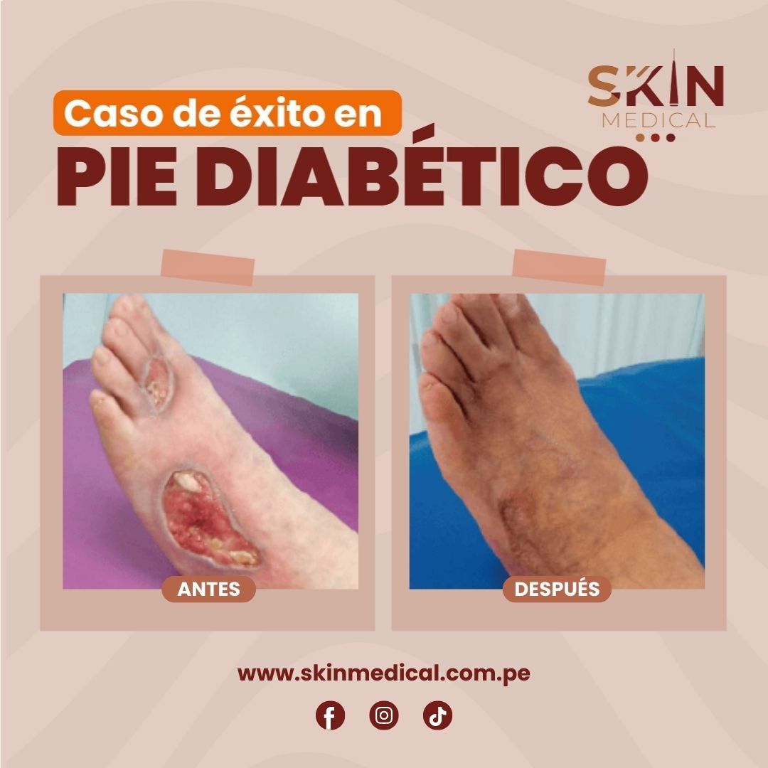 casos exitosos de pie diabetico