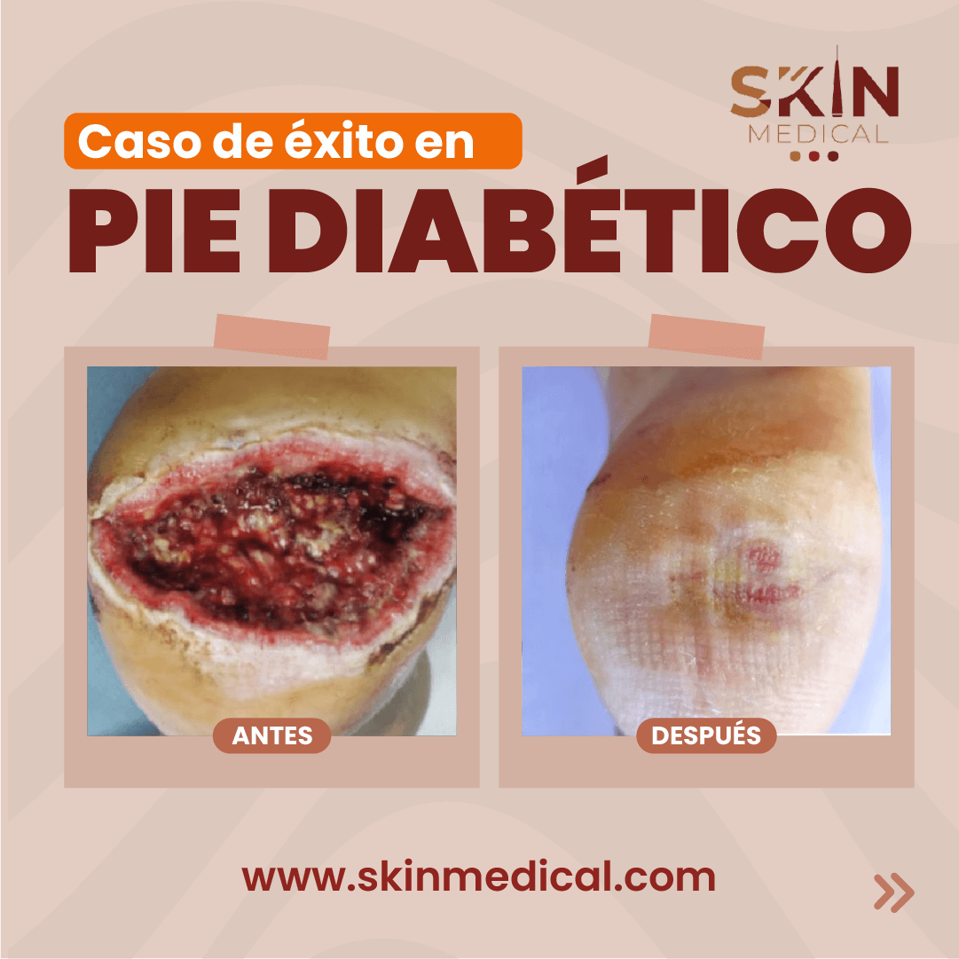 tratamiento-de-pie-diabetico-3.png