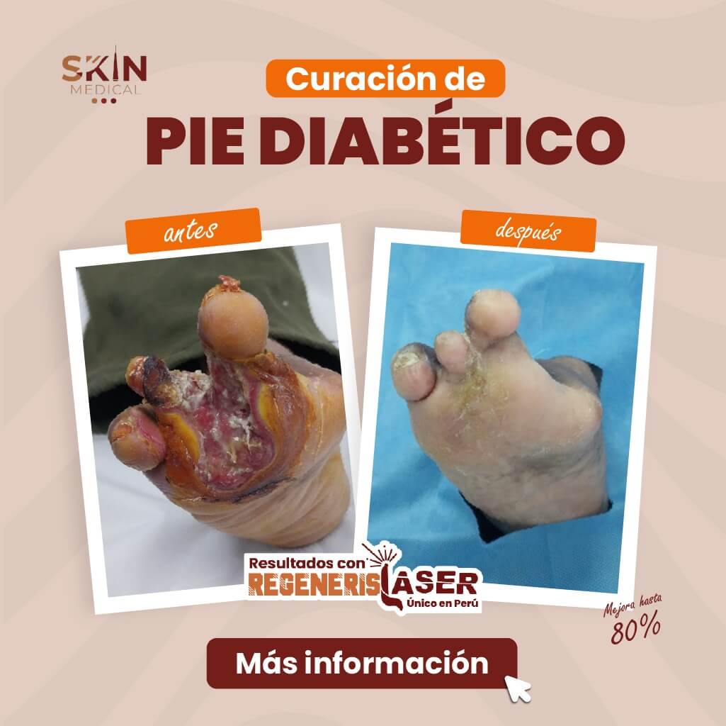 tratamiento-de-pie-diabetico.jpeg