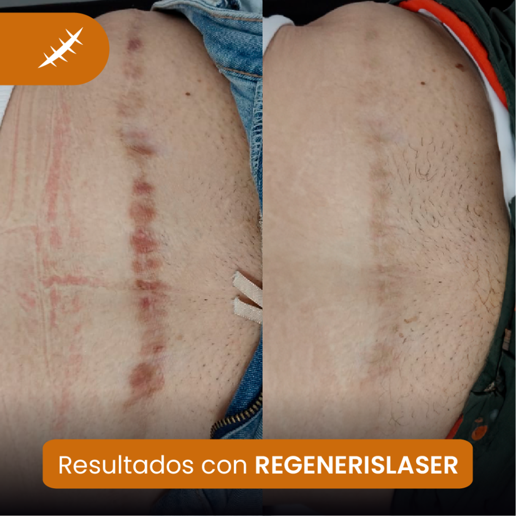 Consulta médica sobre tratamiento de cicatrices, queloides y estrías en Lima