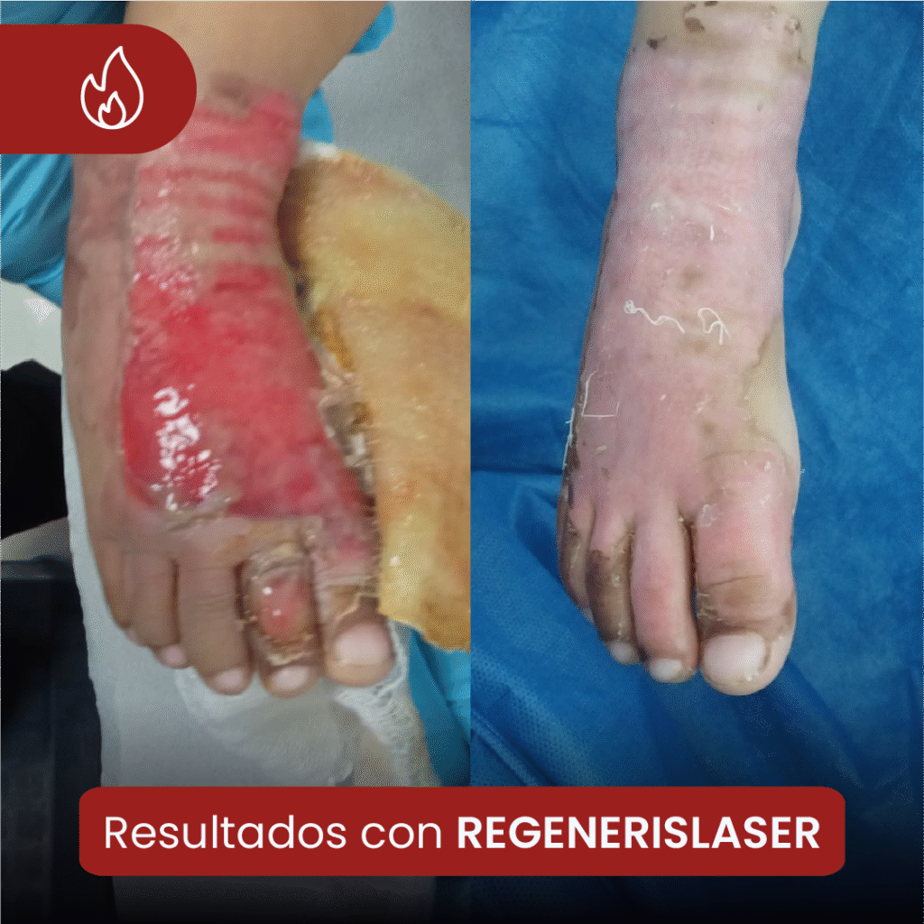 Antes y después Regenerislaser en quemadura de pie con curación avanzada de heridas en SkinMedical