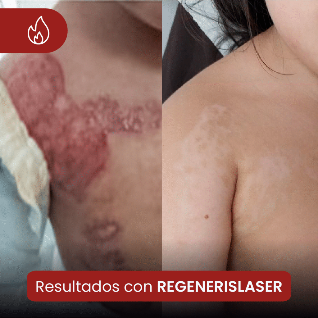 Antes y después de tratamiento láser en cicatriz por quemadura infantil en hombro con regeneración cutánea