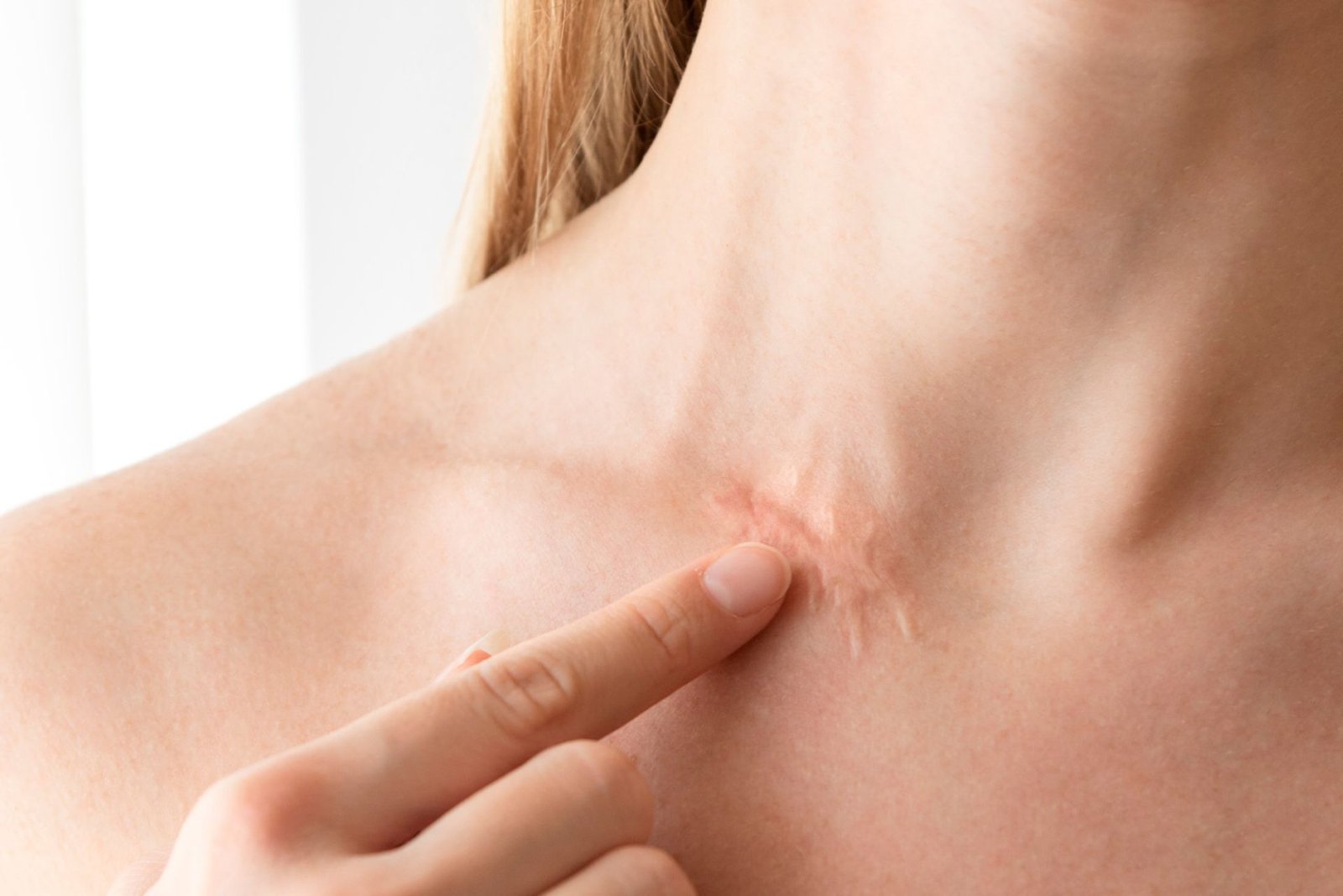 Primer plano de paciente señalando cicatriz hipertrófica en cuello para tratamiento avanzado de cicatrices