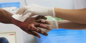 Manejo Inicial de Quemaduras: Qué Hacer Ante una Lesión