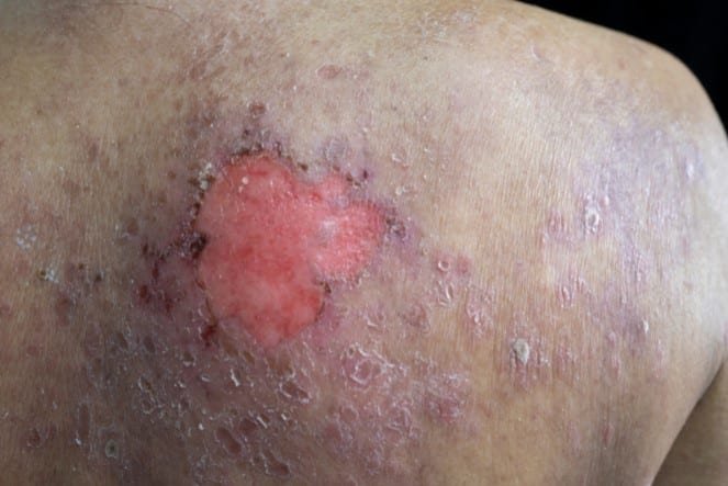 Lesión extensa y descamativa en la espalda con área roja sin piel, herida crónica que puede dejar cicatrices y requiere tratamiento dermatológico avanzado
