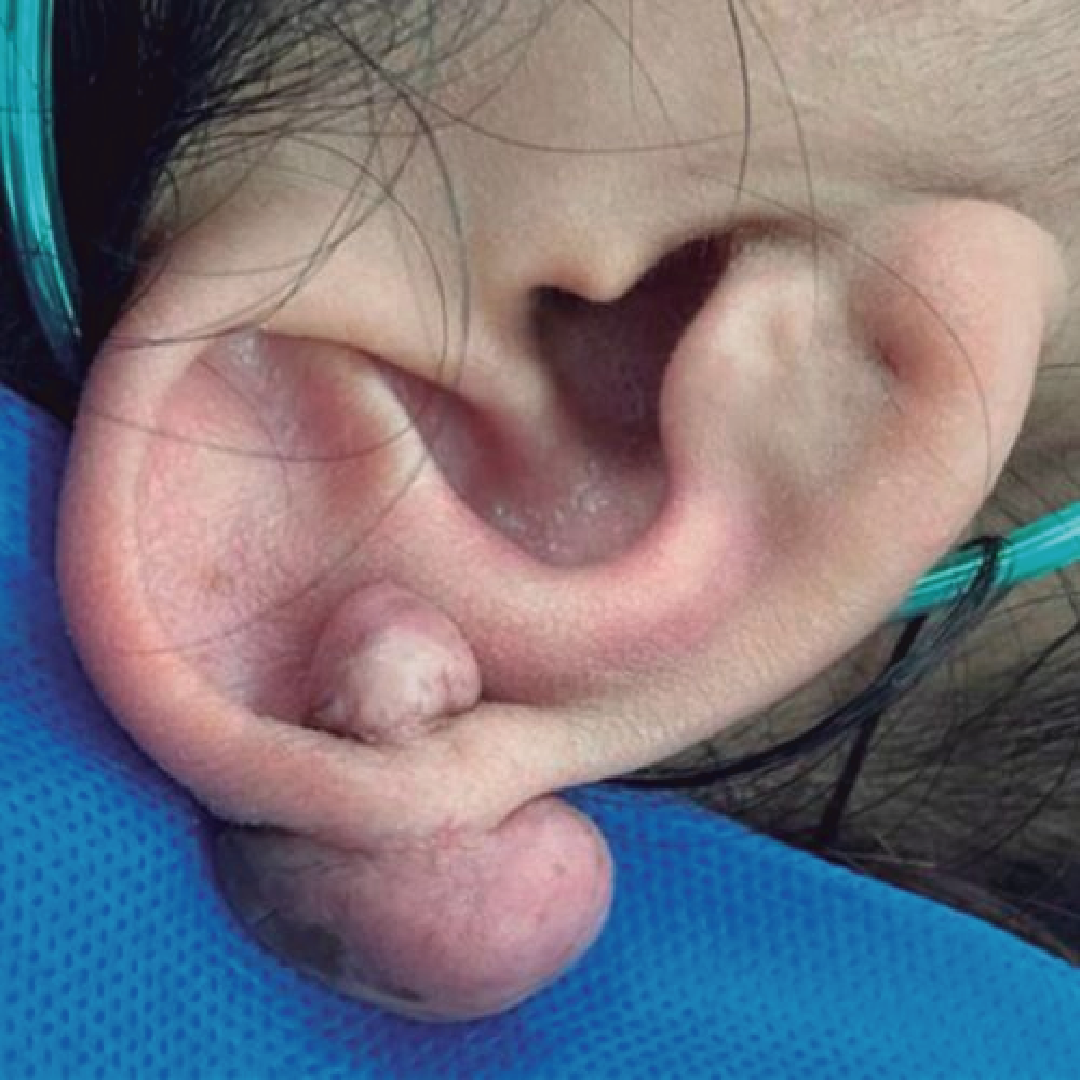 queloide pearcing skin medical (4)