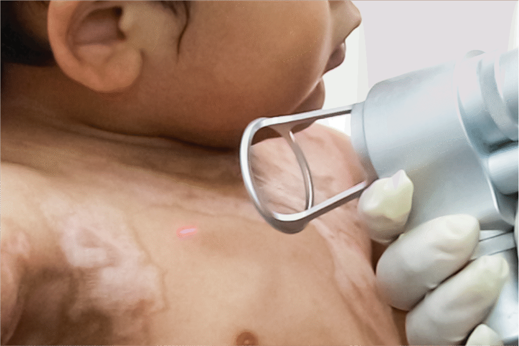 Niño con cicatrices de quemaduras en pecho, recibe tratamiento láser.