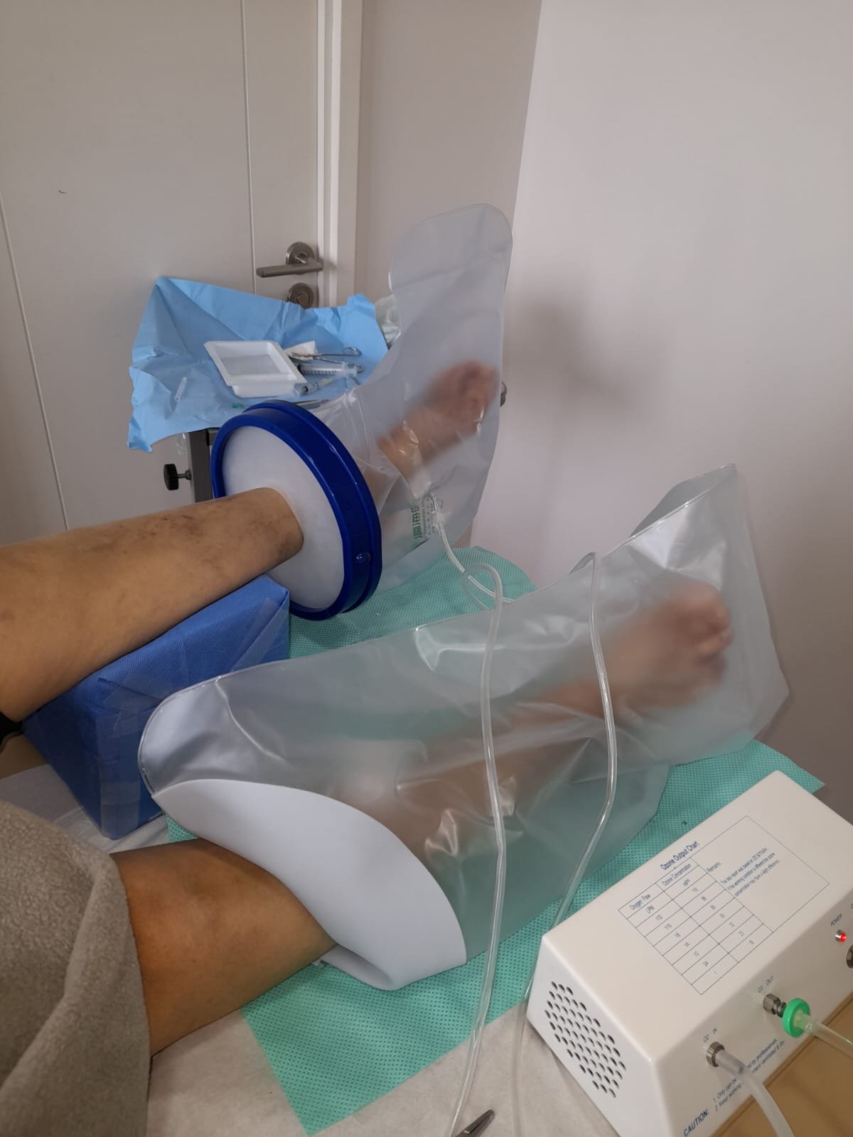 Brazos de paciente en terapia de ozono con equipo médico para cicatrización de quemaduras o heridas.
