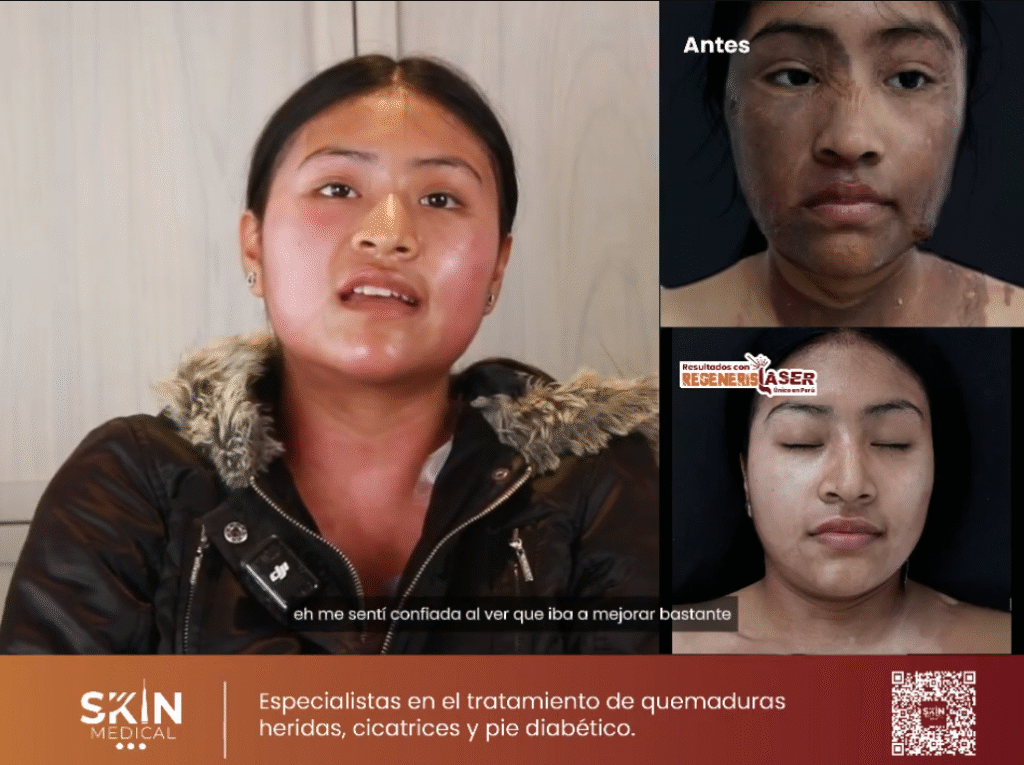 recuperación quemaduras con láser RegenerisLaser