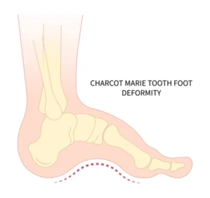 Pie de Charcot: Cómo Identificarlo y Tratarlo