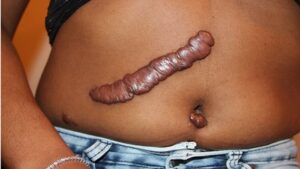 terapia láser de queloides en lima
