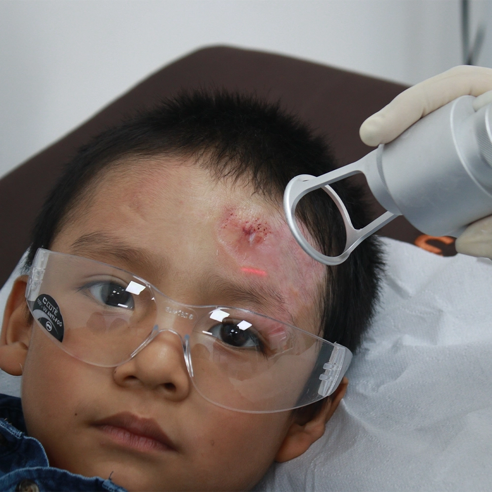 tratamiento de quemaduras