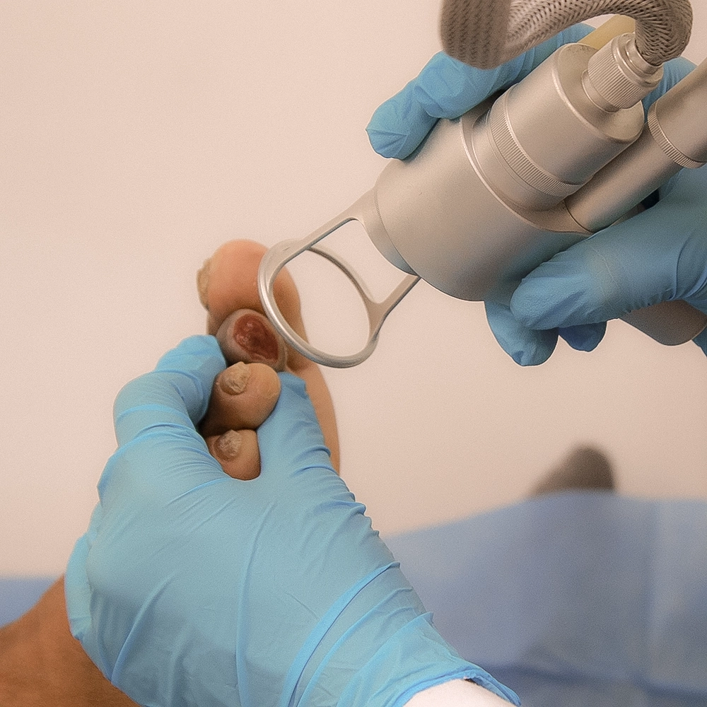 Diagnóstico y tratamiento de pie diabético con tecnología láser. Prevención de amputación y cuidado avanzado de extremidades.