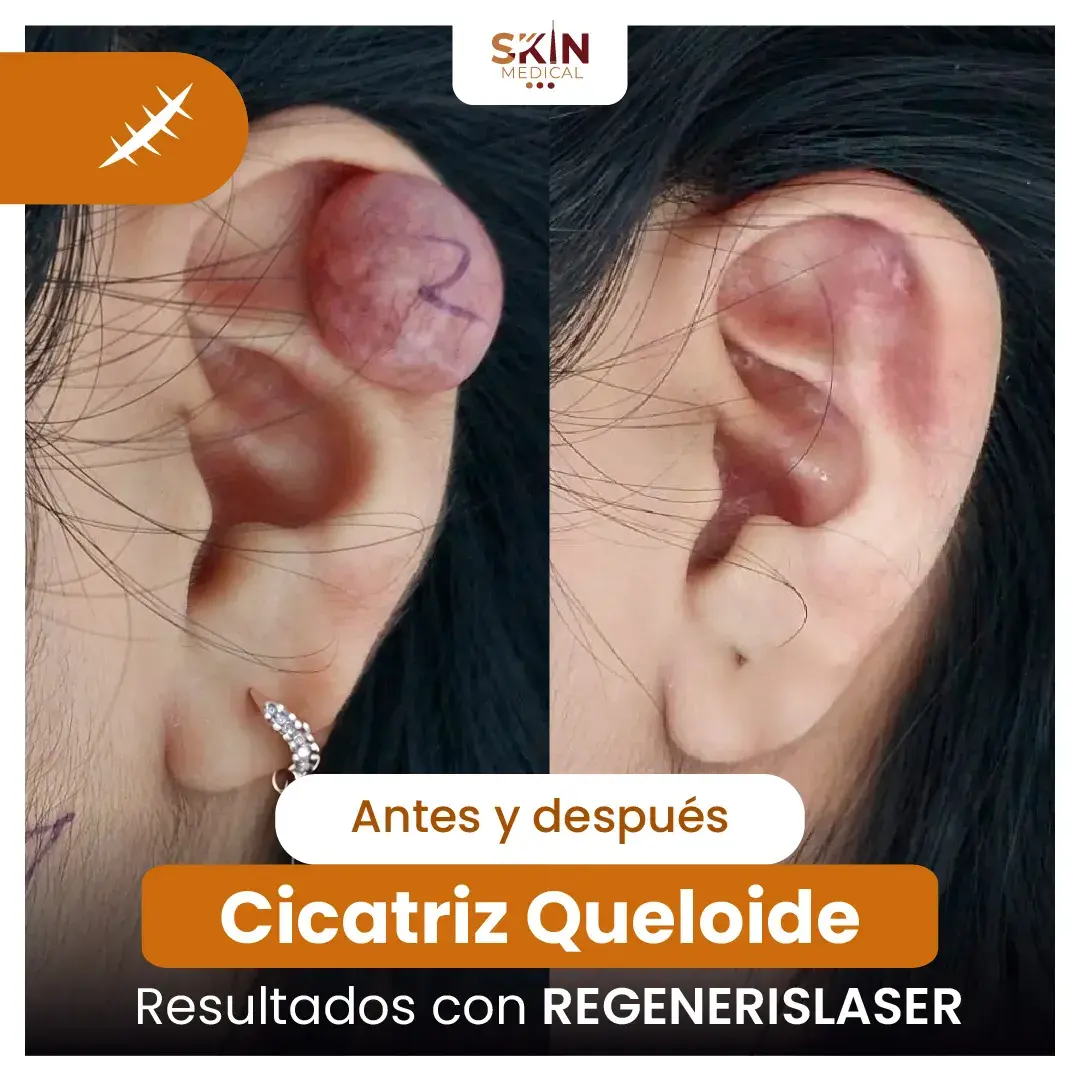 Antes y después: Reducción de cicatriz queloide en oreja con tratamiento REGENERISLASER.