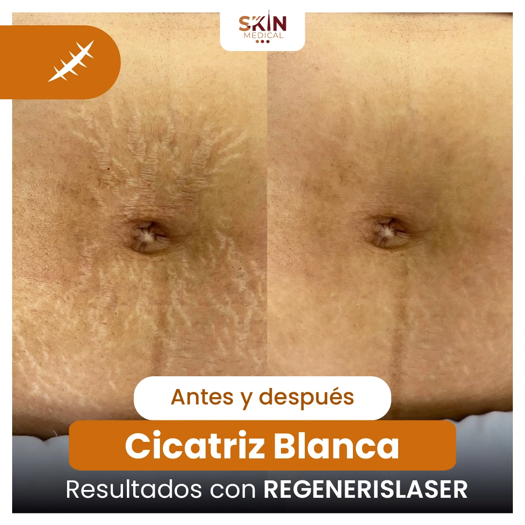 Antes y después de tratamiento láser SKIN MEDICAL para reducir cicatrices blancas en el abdomen.