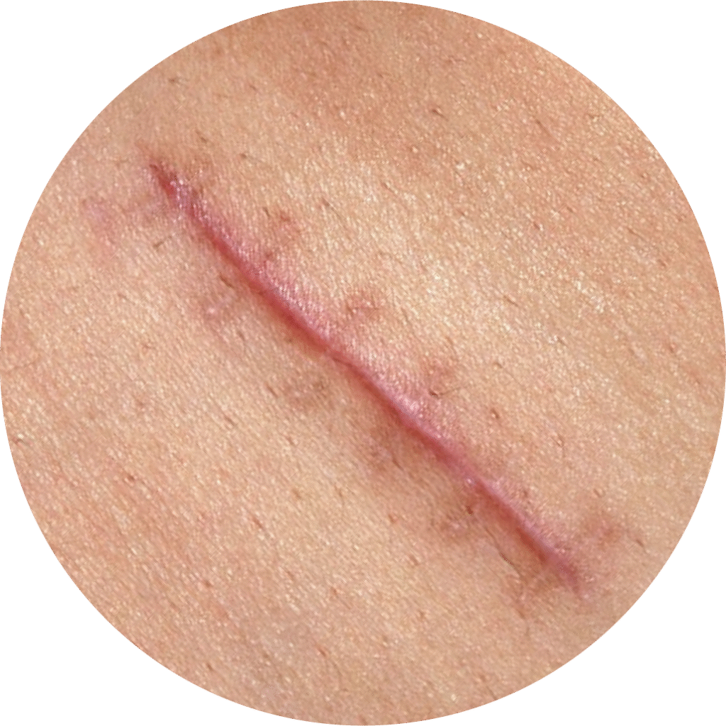 Tratamiento de cicatriz hipertrófica con láser terapia en clínica de cicatrices en Lima