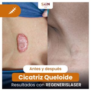 QUELOIDE-ANTES-Y-DESPUES