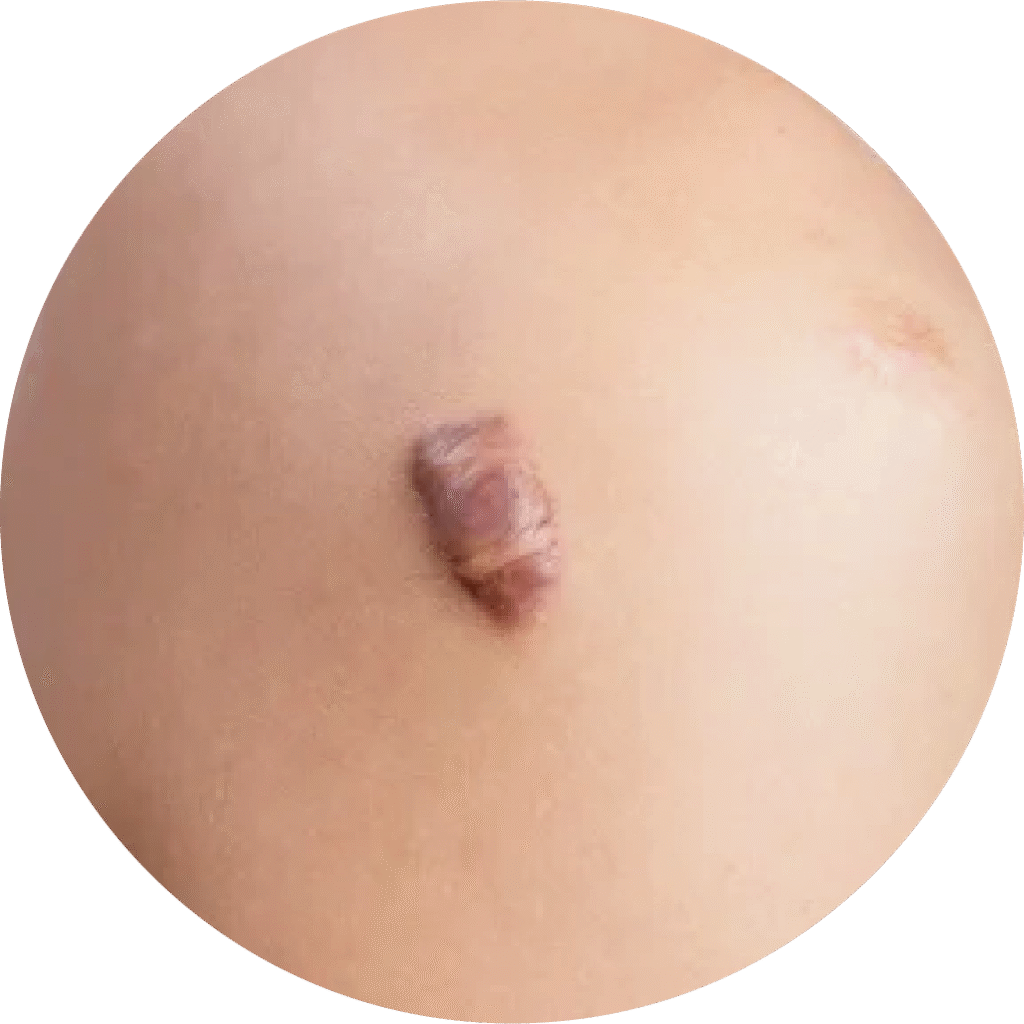 Ejemplo de queloide en piel tratado con láser en especialistas de cicatrices en Lima