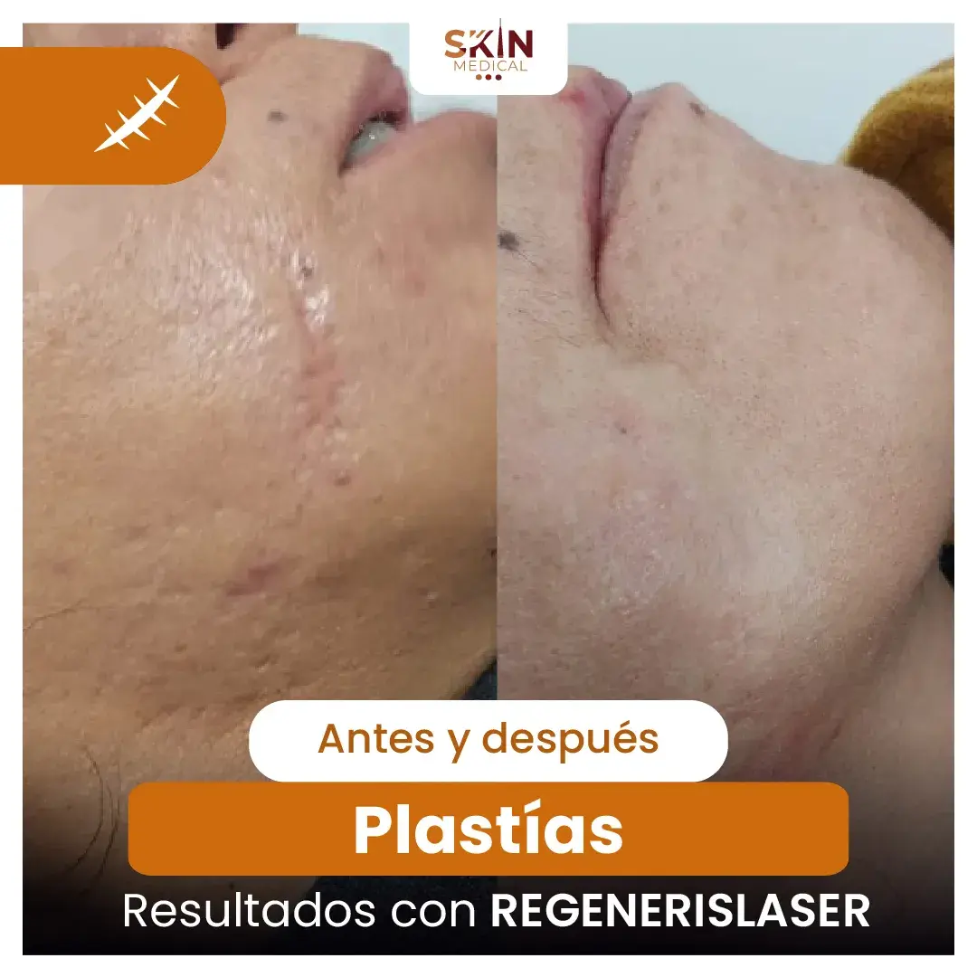 Resultados de láser REGENERISLASER: antes y después de cicatrices faciales significativamente reducidas.