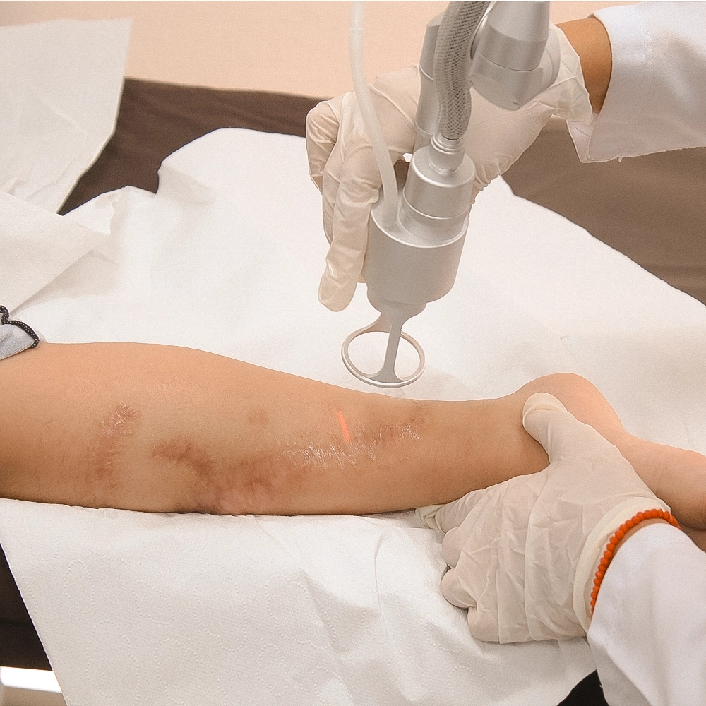 Paciente recibiendo tratamiento láser en cicatrices de quemaduras en la pierna.
