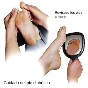 prevención del pie diabético, cuidados del pie diabético, revisión diaria del pie diabético