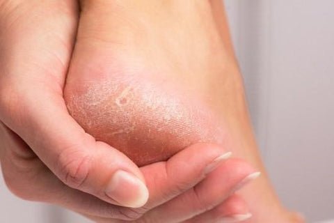 Talón con piel seca y agrietada, una mano lo toca. Importante para la prevención del pie diabético.