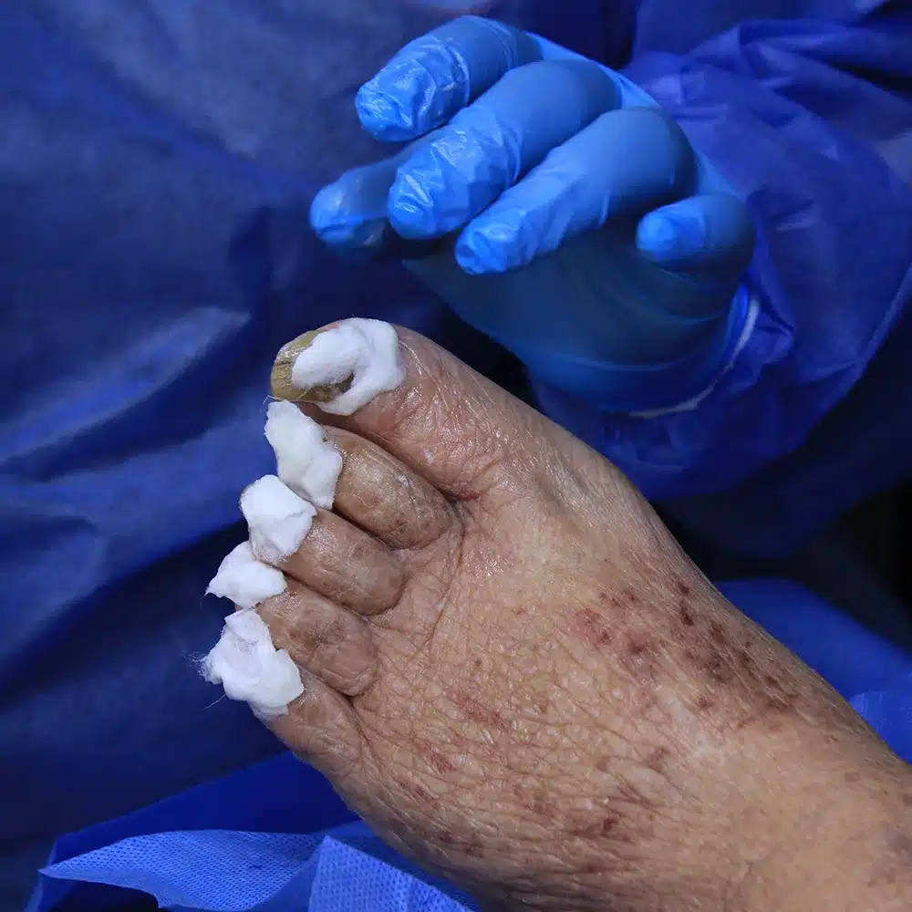 Profilaxis podológica para diabéticos en Skin Medical