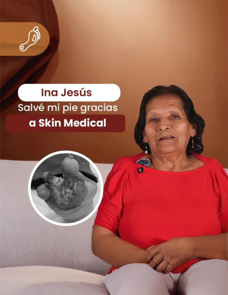 Caso de exito Pie diabetico 2025