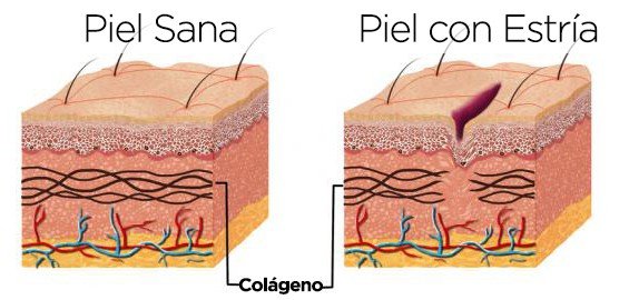 Clínica láser Skin Medical para tratamiento estrías