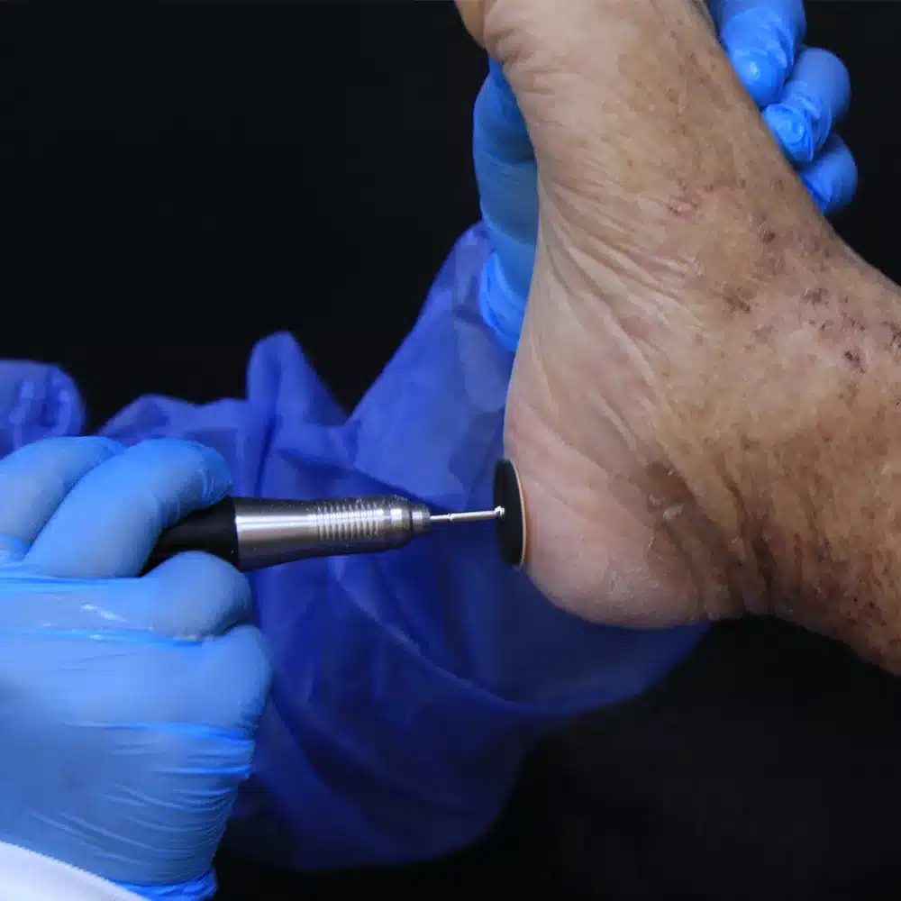 Profilaxis podológica para diabéticos en Skin Medical