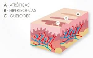 cicatriz