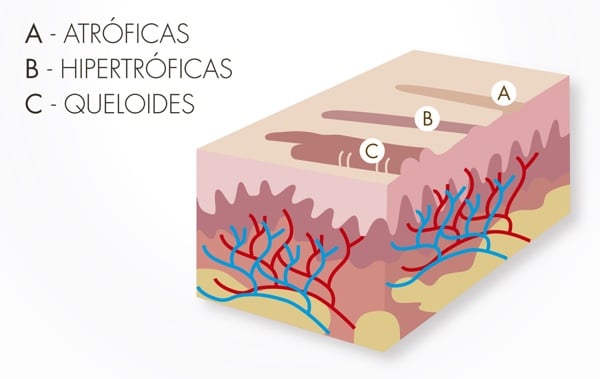 cicatriz