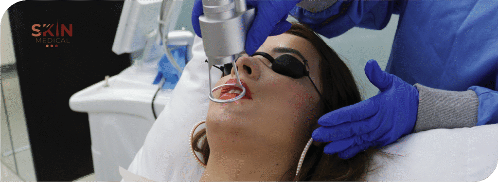 Tratamiento con láser para cicatricez