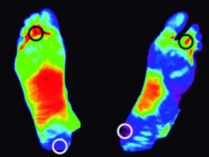 Evaluación térmica del pie bioético con úlcera diabética