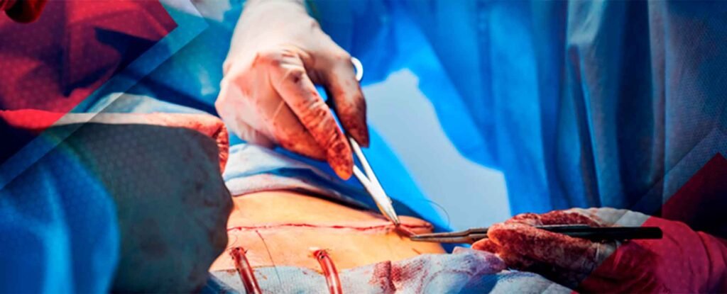 Manos de cirujanos suturando una herida posquirúrgica con tubos de drenaje; guantes y campo estéril ensangrentados.