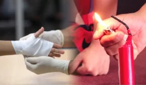 Quemadura en Navidad: Primeros Auxilios y Cuidados