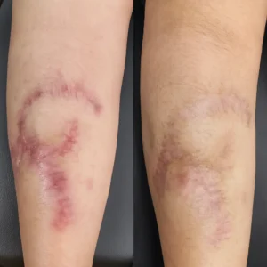 Antes y después del tratamiento de queloides en la pierna con Skin Medical