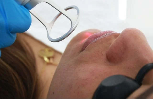 Tratamiento láser para mejorar cicatrices visibles