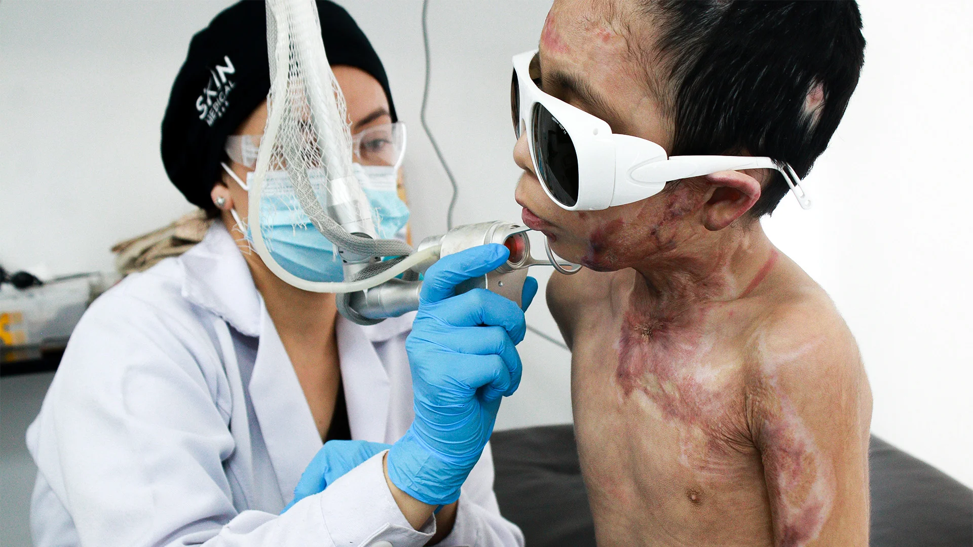 Niño con quemaduras graves: evolución sorprendente