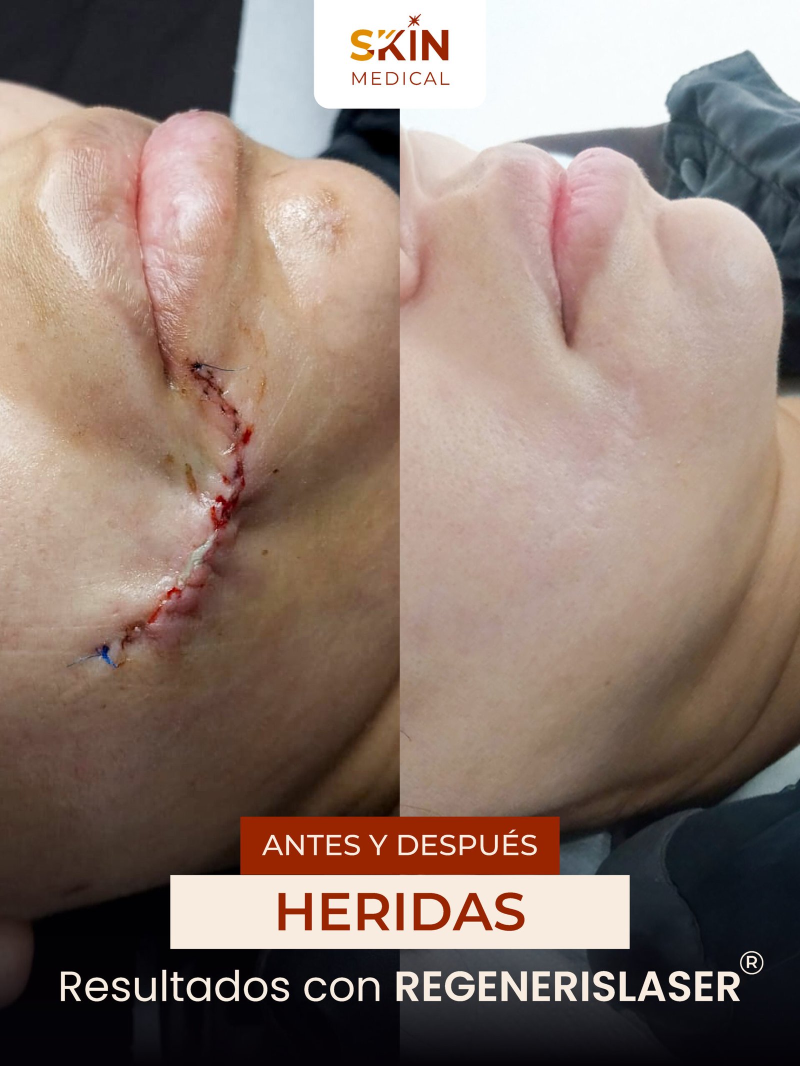 Antes y despues de una cicatriz facial tratado en Skin Medical