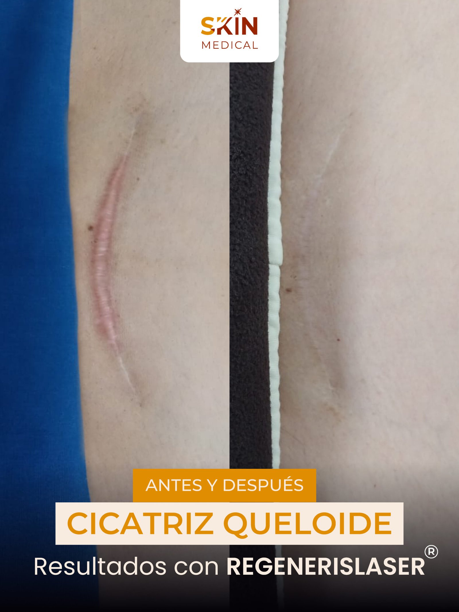 Antes y despues de una cicatriz queloide tratamiento en Skin medical