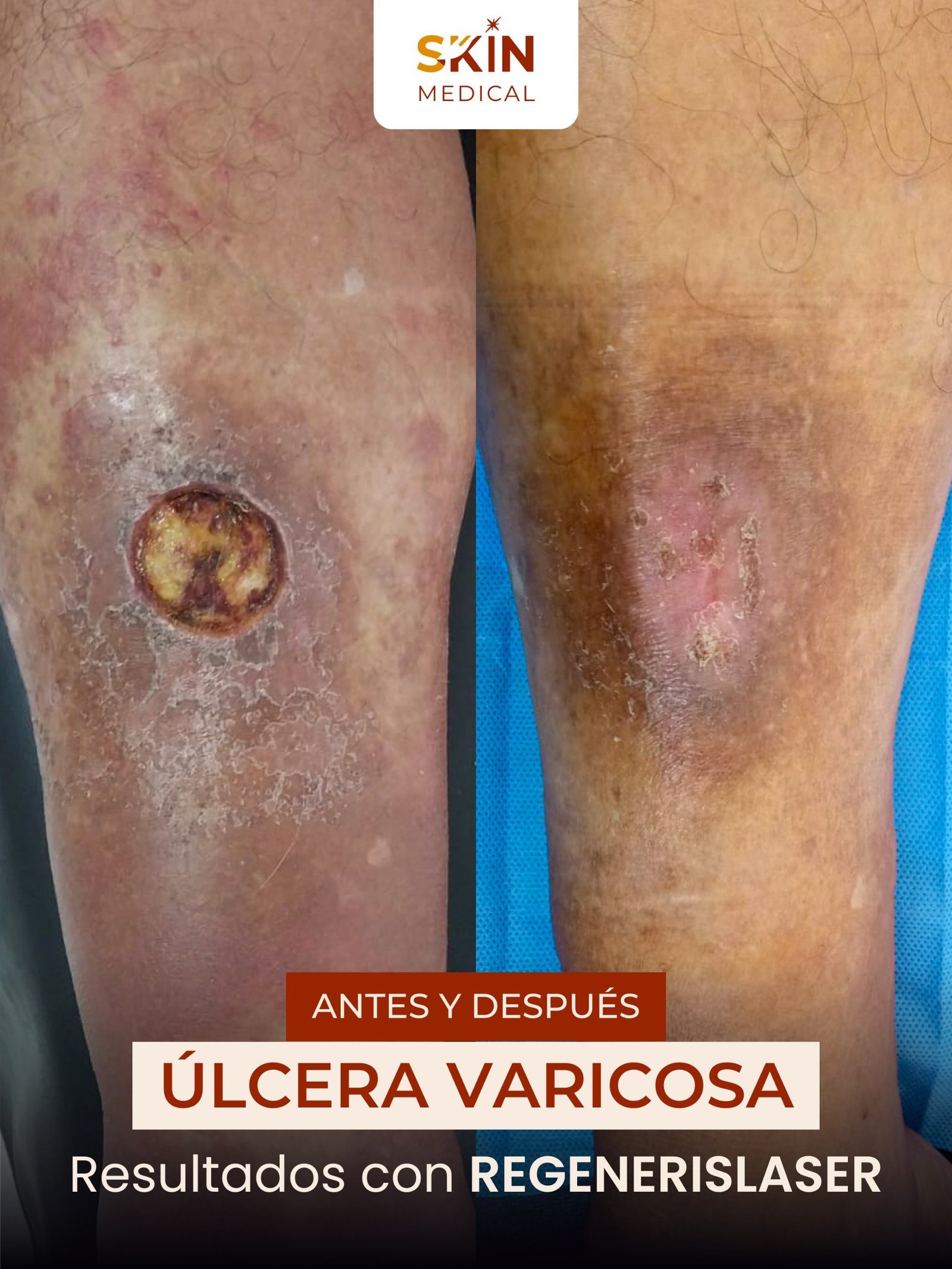 TRATAMIENTO DE ESCARAS SKIN MEDICAL (2)