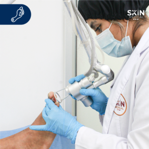 Amputación y Diabetes: Guía para Proteger tus Pies