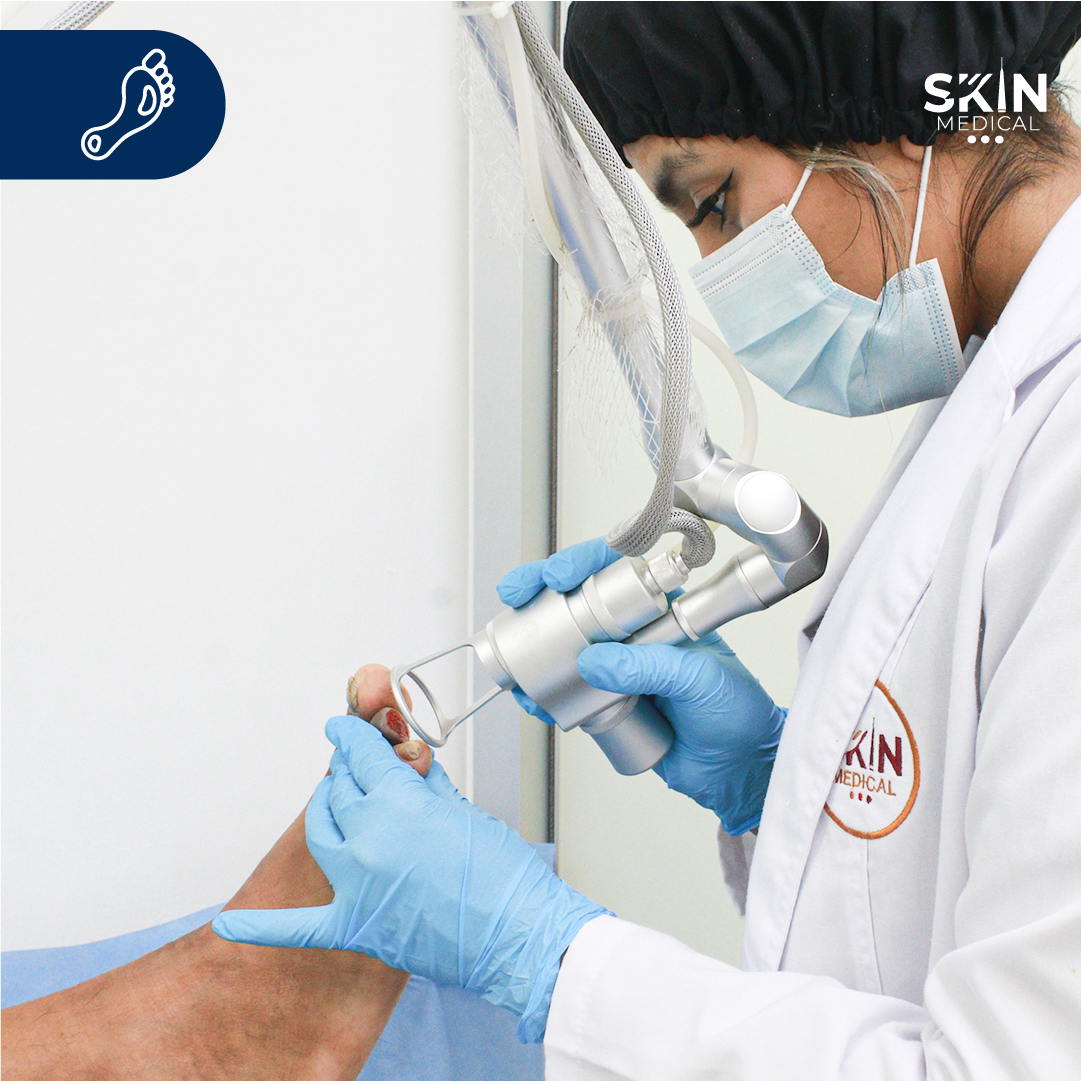 Amputación y Diabetes: Guía para Proteger tus Pies