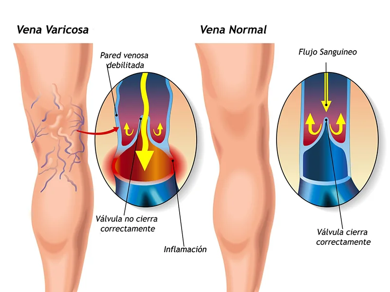 Várices y Úlceras Varicosas: Prevención, Detección y Ejercicios Clave para Combatirlas